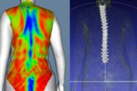 IBV utiliza escaneo corporal dinámico para desarrollar nuevas metodologías para el estudio de deformidades de la columna vertebral